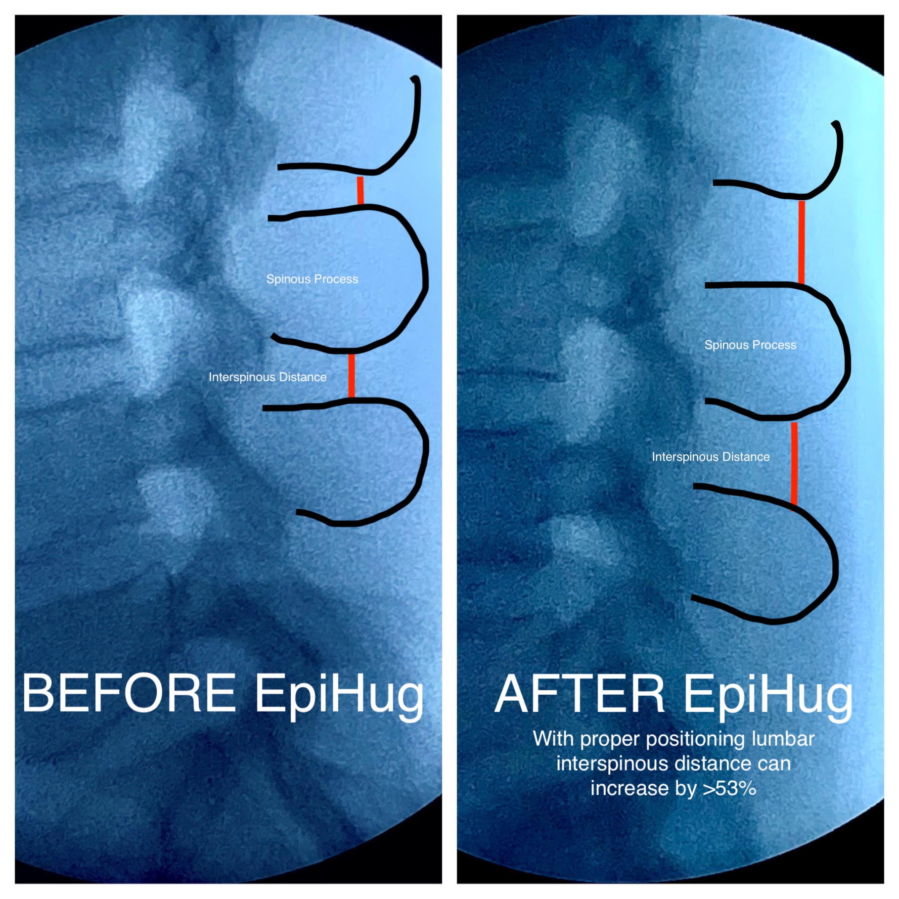 EpiHug® Epidural Ergonomic Patient Positioning Device – Epi-hug